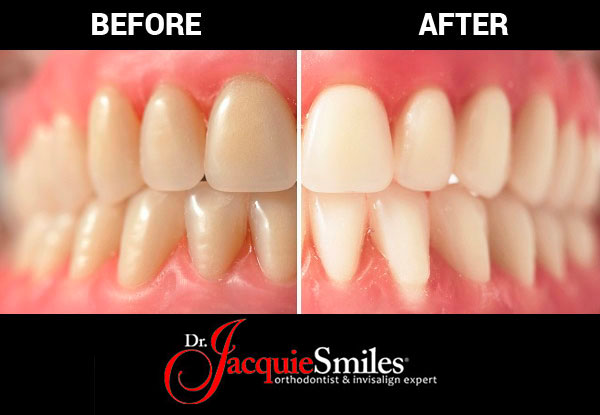 in-office-teeth-whitening-before-after-Monroe-NY.jpg