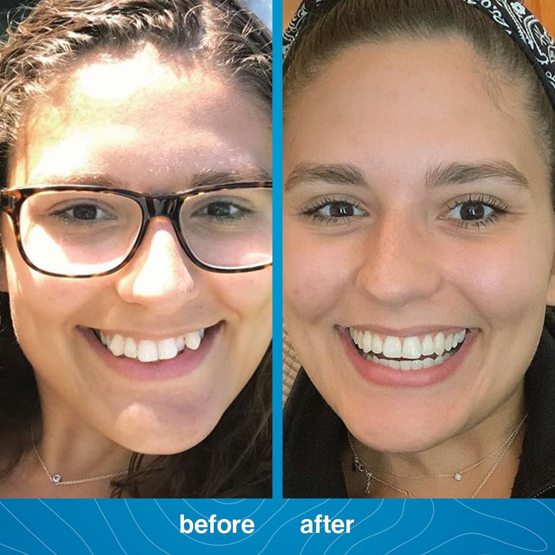 Invisalign Before and After PhotosDr. Jacquie Monroe Ortho