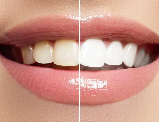 image of before and after teeth whitening