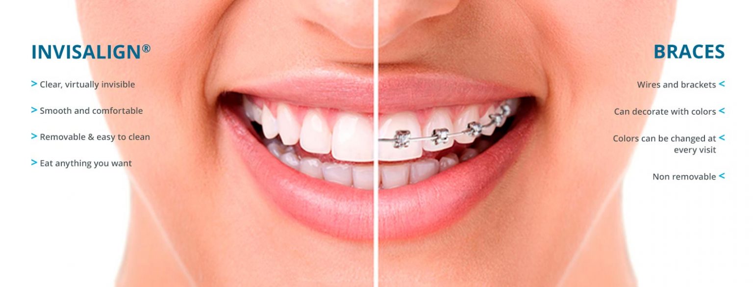 The Differences Between Invisalign vs BracesDr. Jacquie Monroe Ortho