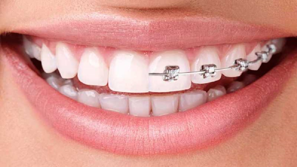 Invisalign vs. Traditional Braces: Which is the Best For You